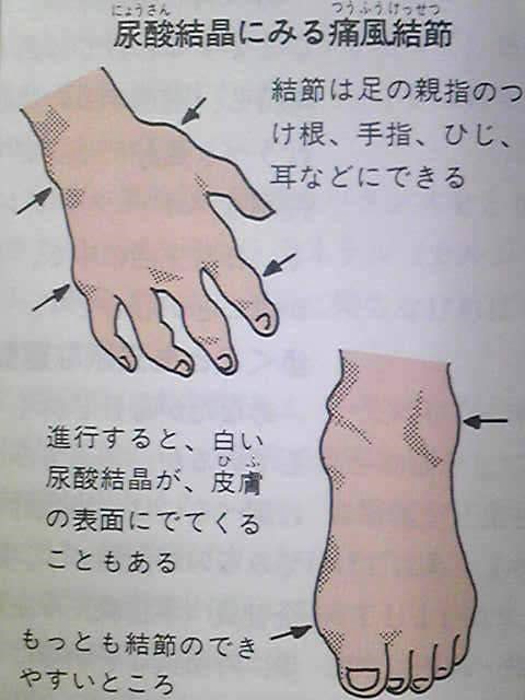 尿酸結晶にみる痛風結節