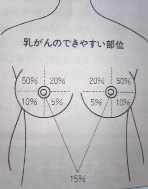 乳ガンのできやすい部位